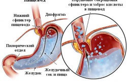 Simptomele Candida și tratamentul esofagitei (candidoză) Candida esofagitei simptome și tratament
