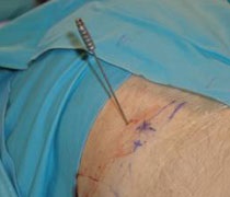 Klinik und poliklinik fuer neurochirurgie informații pacient (poliklinik) Klinik und poliklinik fuer neurochirurgie informații pacient