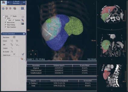 Tomografia computerizată a tractului hepatic și biliar (Ficat) Tomografia computerizată a ficatului și a tractului biliar