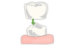 argumente pro și contra de proiectare ceramice Crown