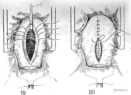 sectiunea cezariana corporeal - livrare abdominale (corporale) cezariana corporeal - livrare abdominale