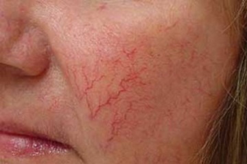 Cosmetice alb Linen - gama, aplicare recenzii cosmetologi și consumatori (produse cosmetice lenjerie albă) Cosmetice alb In - gama, cerere comentarii cosmetologi și consumatori