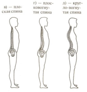 Kruglovognutaya plano și înapoi plat înapoi la copil, exerciții (plano) Kruglovognutaya plano și înapoi spate plat la copil, exerciții