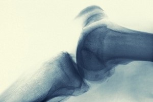 Tratamentul osteoartritei a principiului de funcționare cu laser a genunchiului (artroze) Tratamentul osteoartritei a principiului de funcționare cu laser a genunchiului