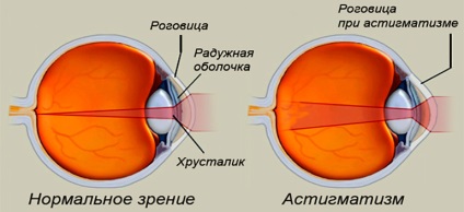 Tratament de astigmatism - centrul de chirurgie ochi (ochi centru de chirurgie tratament clinica Bucuresti ochi viziune chirurgie cu laser ochi chirurgie medic) Tratament de astigmatism - Eye Surgery Center