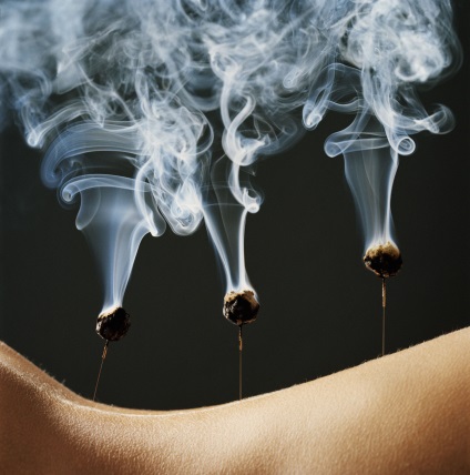 acupunctura tratament (acupunctura) acupunctura tratament