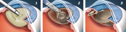 Tratamentul cataractei facoemulsionare, eliminarea - este necesar să se cunoască (necesar) Tratamentul cataractei facoemulsionare, eliminarea - trebuie să știți