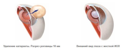 Tratamentul cataractei facoemulsionare, eliminarea - este necesar să se cunoască (tratament) Tratamentul cataractei facoemulsionare, eliminarea - trebuie să știți