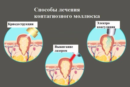 Tratamentul pentru molluscum contagiosum într-un copil semne, fotografii