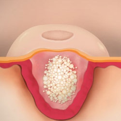 Tratamentul pentru molluscum contagiosum într-un copil semne, fotografii