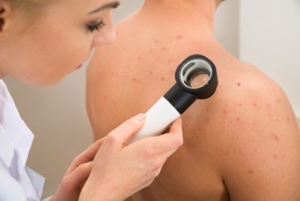 Tratamentul pentru molluscum contagiosum la un copil semne, fotografie (tratament) Tratamentul pentru molluscum contagiosum într-un copil semne, fotografii