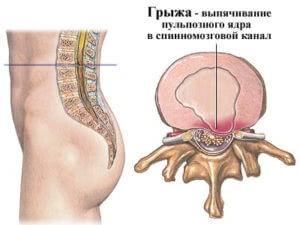 Metode de tratament alternative herniate (intervertebrale) Tratamentul metodelor alternative herniate