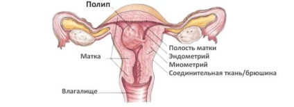 полипи в народни средства за защита на матката лечение - Методи и ревюта