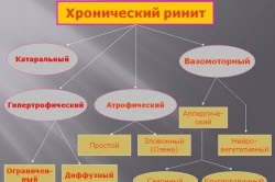 Tratamentul rinitei cronice la copii (cronică) Tratamentul rinitei cronice la copii