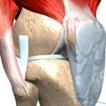 Ligamentoz genunchiului și a ligamentelor cruciat (genunchi) Ligamentoz genunchiului și a ligamentelor cruciat