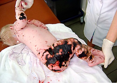 Antimeningococic patogen bolii, epidemiologie, patogeneza, imunitatea (patogen) Antimeningococic patogen bolii, epidemiologie, patogeneza, imunitatea