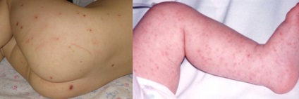 Antimeningococic patogen bolii, epidemiologie, patogeneza, imunitatea (patogen) Antimeningococic patogen bolii, epidemiologie, patogeneza, imunitatea