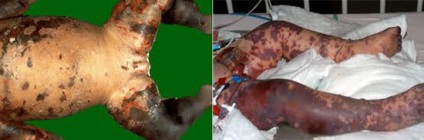 Antimeningococic patogen bolii, epidemiologie, patogeneza, imunitatea (patogen) Antimeningococic patogen bolii, epidemiologie, patogeneza, imunitatea