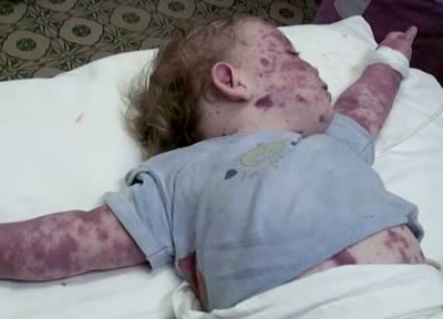 Antimeningococic patogen bolii, epidemiologie, patogeneza, imunitate (meningococ) Antimeningococic patogen bolii, epidemiologie, patogeneza, imunitatea