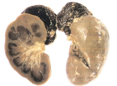 Antimeningococic patogen bolii, epidemiologie, patogeneza, imunitatea (patogen) Antimeningococic patogen bolii, epidemiologie, patogeneza, imunitatea