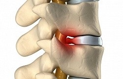 Tratamentul intervertebral hernie si simptome (boala intervertebral hernie) Tratamentul hernie intervertebral și simptome