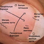 Determinarea bolii pe unghii (unghii definesc boala) Definiția bolii pe unghii