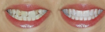 Proprietățile și metodele de restaurare dentare estetice (fiecare pacient individual) Proprietățile și metodele de restaurări dentare estetice
