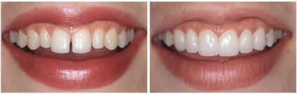 Proprietățile și metodele de restaurare dentară estetică (dinte de restaurare estetice) Proprietățile și metodele de restaurări dentare estetice