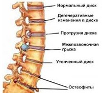 simptomele de osteoartrita si tratamentul osteoartritei generalizate a coloanei vertebrale și a articulațiilor (osteoartrita) simptomele de osteoartrita si tratamentul osteoartritei generalizate a coloanei vertebrale și a articulațiilor