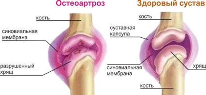 simptomele de osteoartrita si tratamentul osteoartritei generalizate a coloanei vertebrale și a articulațiilor (tratament) simptomele de osteoartrita si tratamentul osteoartritei generalizate a coloanei vertebrale și a articulațiilor