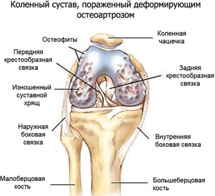 simptomele de osteoartrita si tratamentul osteoartritei generalizate a coloanei vertebrale și articulații (simptome) simptomele de osteoartrita si tratamentul osteoartritei generalizate a coloanei vertebrale și a articulațiilor