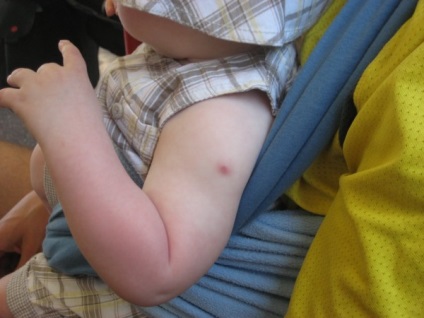 Ce vaccin BCG și când se face (vaccin) Ce vaccin BCG și atunci când se face