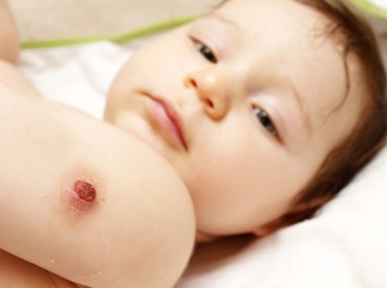 Ce vaccin BCG si cand se face (ce) Ce vaccin BCG și atunci când se face