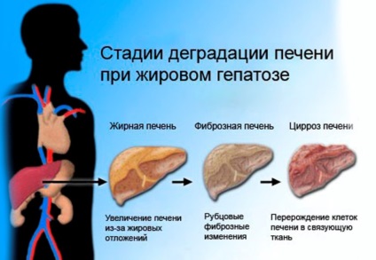 simptome hepatice Obezitatea, diagnostic, tratament