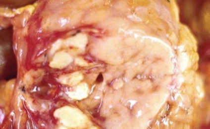 Obezitatea pancreas, pancreatita (pancreatic) pancreas obezitate, pancreatita