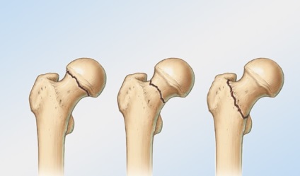 Fractura de femur cu o schimbare și de reabilitare după o intervenție chirurgicală (sold) Fractura de femur cu deplasare și de reabilitare după o intervenție chirurgicală