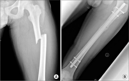 Fractura de femur cu o schimbare și de reabilitare după o intervenție chirurgicală (reabilitare) Fractura de femur cu deplasare și de reabilitare după o intervenție chirurgicală
