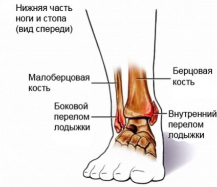 Fractura de glezna tratate cu deplasare și restaurare (recuperare) Glezna deplasate tratamentul fracturii și de recuperare