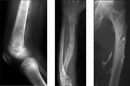 fractura glezna cu deplasare a simptomelor și a tratamentului (tratament) Simptomele fracturate glezna offset și tratament