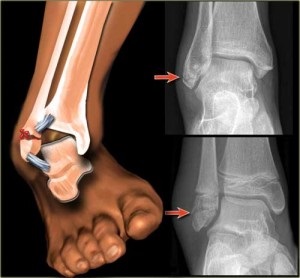 fractura glezna cu deplasare a simptomelor si tratamentul (simptomelor) Simptomele fracturate glezna offset și tratament
