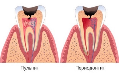 simptome periodontita, tratament (tratament) simptome parodontita, tratament