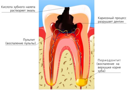simptome periodontita, tratament (tratament) simptome parodontita, tratament