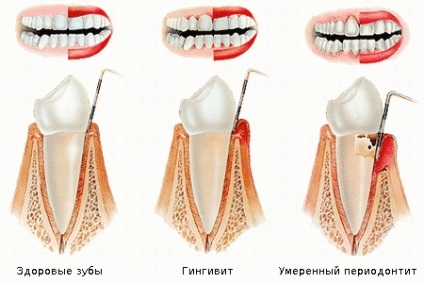 simptome periodontita, tratament (simptome) simptome parodontita, tratament