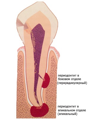 Simptomele periodontita, tratamentul (simptomele bolii parodontale) simptome parodontita, tratament