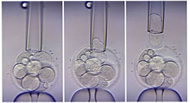 PGD FIV - Ce este (FIV cu PGD) PGD FIV - Ce este