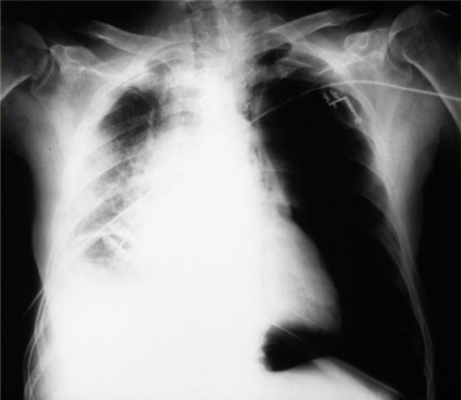 Pneumotorax pulmonare cauze, simptome si tratament (simptome) Pneumotorax pulmonare cauze, simptome și tratament