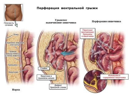 Postoperator stomac hernie ventrală ce este, cauzele, tratamentul (perioada postoperatorie hernie ventrală) Postoperator stomac hernie ventrală ce este, cauze, tratament