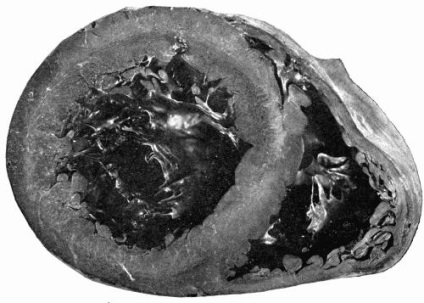Dreptul de ventricul Cauzele hipertrofia (ventricul) Cauzele hipertrofie ventricul drept