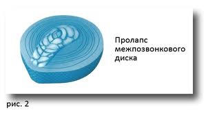 Spinala de disc prolaps, coloana vertebrală (coloana vertebrală) Spinala de disc prolaps, șira spinării