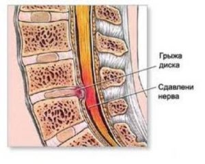 Prolapsul discului intervertebral - l (discul) Prolaps discului intervertebral - ceea ce este